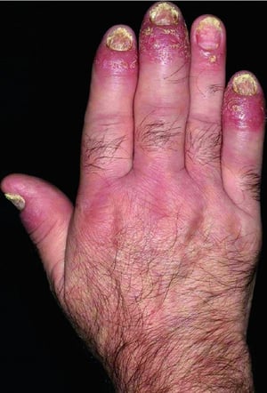 Artritis psoriásica (dactilitis)