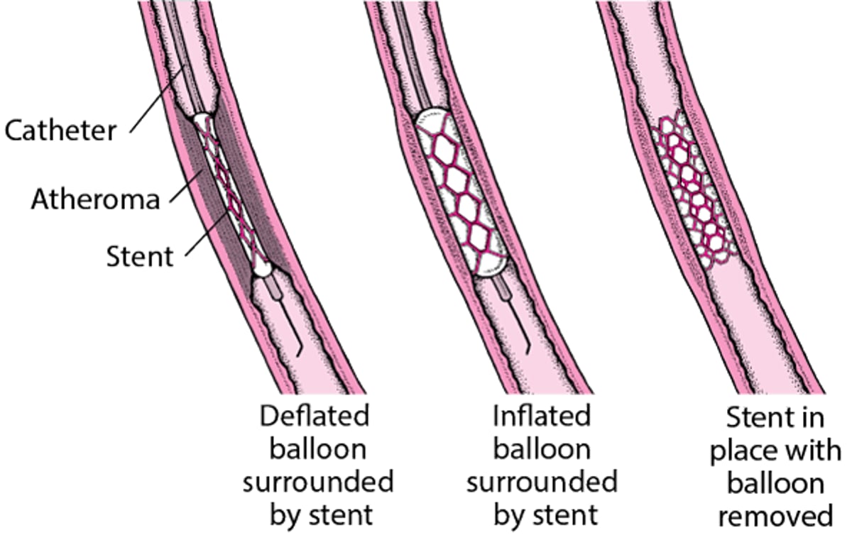 Understanding Percutaneous Coronary Intervention (PCI)