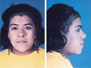 Acromegalia (vistas frontal y lateral de los cambios faciales)
