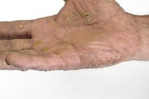 Psoríase palmoplantar (palmas das mãos)