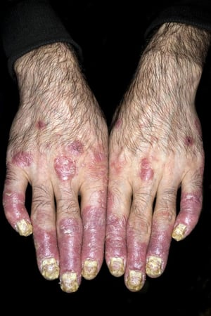 Psoríase (dedos)
