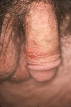 Genital Warts (Male)