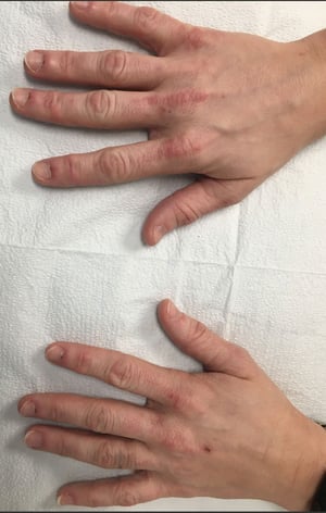 Gottron Papules (2)