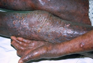 Micose fungoide