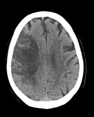 Subakuter MCA-Infarkt (CT)